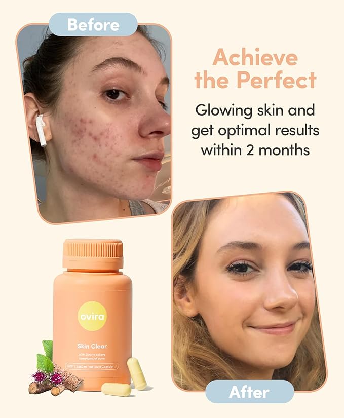Ovira Skin Clear with ZINCBRIGHT - 60 Capsules for Clear & Glowing Skin | Rosacea & Hormonal Acne Treatment with Vitamin C | Support Collagen Production | Acne Supplements for Women & Men - Pack of 1