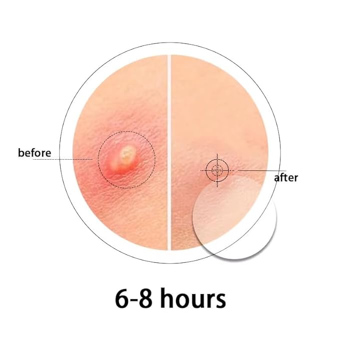 M MACIBOI Hydrocolloid Acne Pimple Patches - Overnight Whiteheads and Blemishes - acne dots pimple patches - Invisible Zit Stickers for Face and Spot Covers - Suitable for All Skin Types | 72 Count |