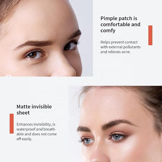 Hydrocolloid Pimple Patches for Face – 144 Count Invisible Acne Spot Dots | Fast-Acting, Waterproof Zit Stickers | Non-Irritating Blemish Patches for Overnight Healing
