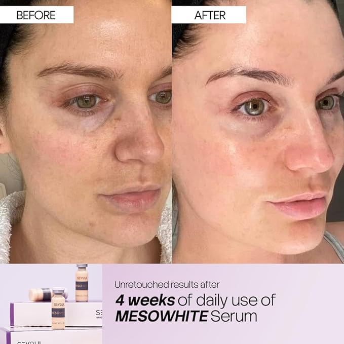 Meso White Facial Serum Ampoules – Uneven Tone Appearance & Skin Radiance Support with Niacinamide, Stem Cells & Collagen – 6 Vials (0.17 fl oz Each)