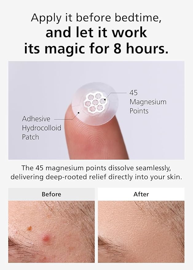 DWEasyDerm EasyDerm Magnesium Pimple Patches – Hydrocolloid Acne Spot Treatment with Ampoule & Tweezer, 10 Calming Zit Stickers by Daewoong, 이지덤, 대웅제약