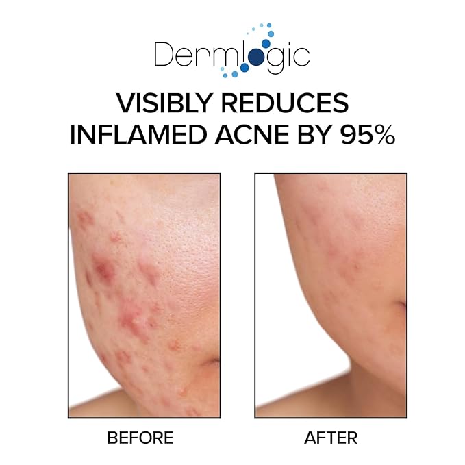 Acne Treatment Pads-Contains Glycolic, Lactic, Salicylic Acid. Eliminates Oily Skin, Clogged Pores & Cystic Breakouts. Removes Dark Spots, Whitehead & Blackhead Pimples for Face & Body.