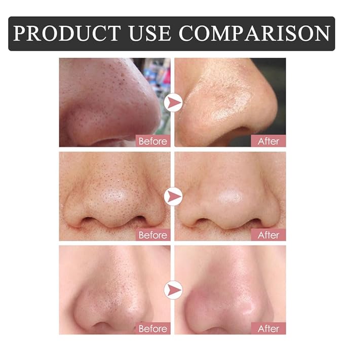 Blackhead Remover Nose Pore Strips - Deep Cleansing and Moisture Clear-Up Strips for Blackheads, for Women & Men (20 PCS)