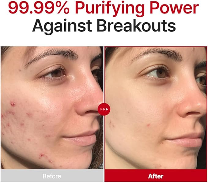 PURITO Hypochlorous Acid Facial Spray | Witch Hazel 5% + Forest Breeze | HOCl Facial Mist for Sensitive, Redness-Prone Skin | Refreshing Toner Mist | Korean Skincare, 100mL / 3.38 fl.oz