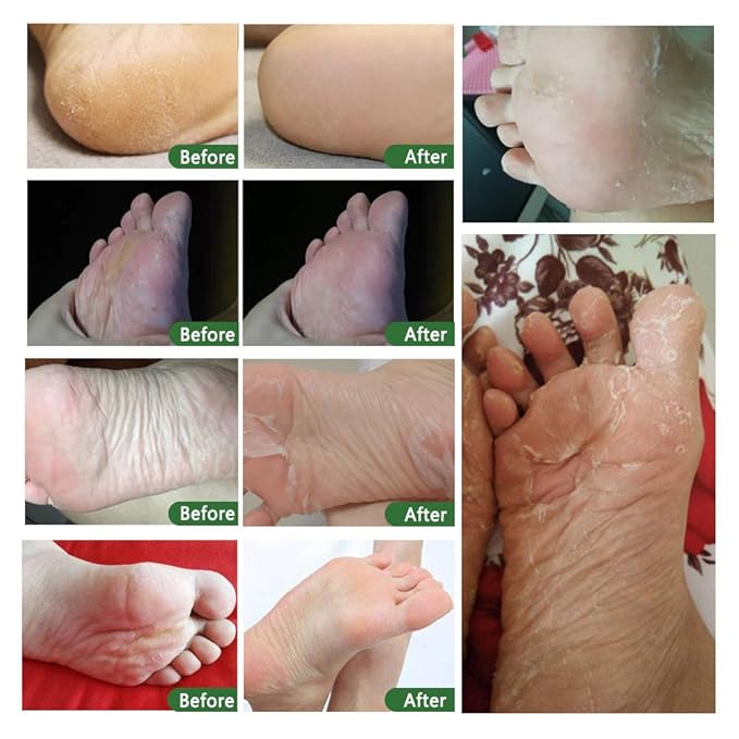 Foot Peel Mask 3 Pack， Exfoliator Peel Off Calluses Dead Skin Callus Remover，Soft Smooth Touch Feet-Men Women (Tea Tree)