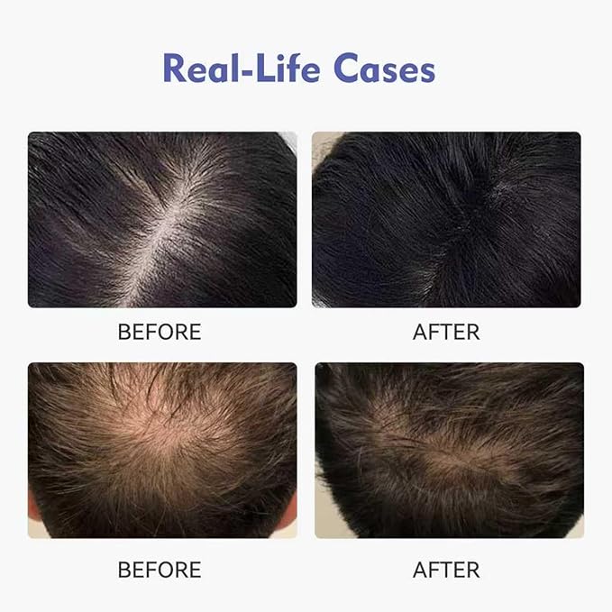 KINTOR 0.9% KX-826 DHT Blocker for Men & Women Hair Growth,Hair Growth Products Foam 60ml Pro