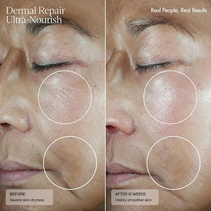 Senté Dermal Repair Ultra-Nourish | Rosacea Treatment for Dry, Sensitive Skin | Repairs, Replenishes & Reduces Skin Redness | 1.7 Fl Oz
