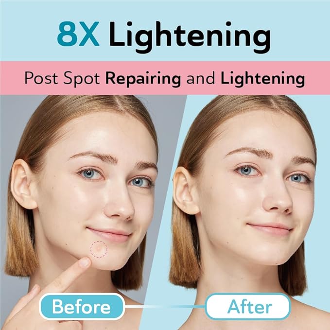 DERMA ANGEL Dark Spot Patches Blemish Patches with Hydrocolloid, TXA & CICA for Active Acne & Post-Inflammatory Dark Spots - Day and Night Use - UPGRADED (Post Acne - 36 Count - 2 Size)
