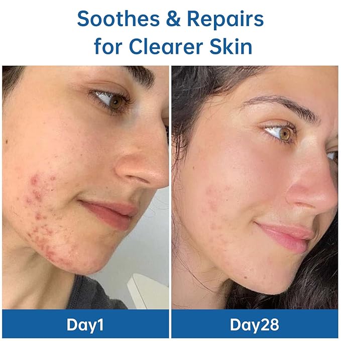 Even Tone & Blemish Serum - Skin Brightening & Repair Treatment for Face | Reduces Dark Spots & Acne Marks | Nourishing Smoothing Formula for All Skin Types, 1 fl.oz/30ml