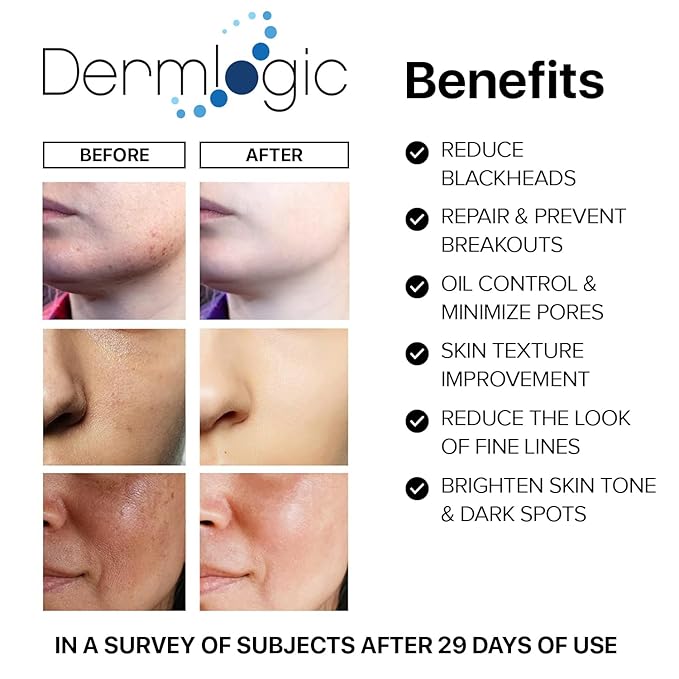 Acne Treatment Pads-Contains Glycolic, Lactic, Salicylic Acid. Eliminates Oily Skin, Clogged Pores & Cystic Breakouts. Removes Dark Spots, Whitehead & Blackhead Pimples for Face & Body.