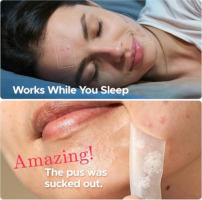 6、LitBear Large Pimple Patches, 5 Sizes 324 Patche Big Acne Patches, XL Hydrocolloid Bandages for Full Face, Forehead, Chin, Nose, Body, Back, Neck & Chest, Stirp, Square Large hydrocolloid Patch