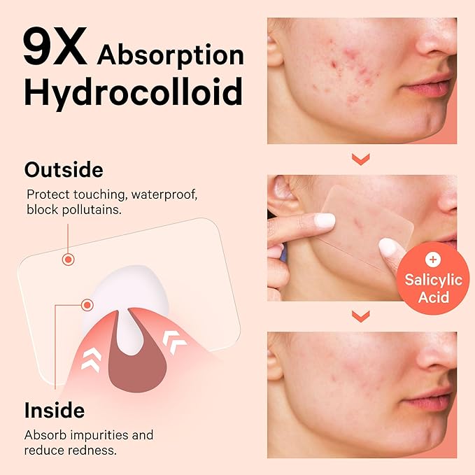 Sosky Large Pimple Patches XL Hydrocolloid Acne Patches for Face & Body Cystic Pimple & Zit Patch for Nose Chin Back, Bacne & Breakouts Vegan Cruelty-Free（12 Count）