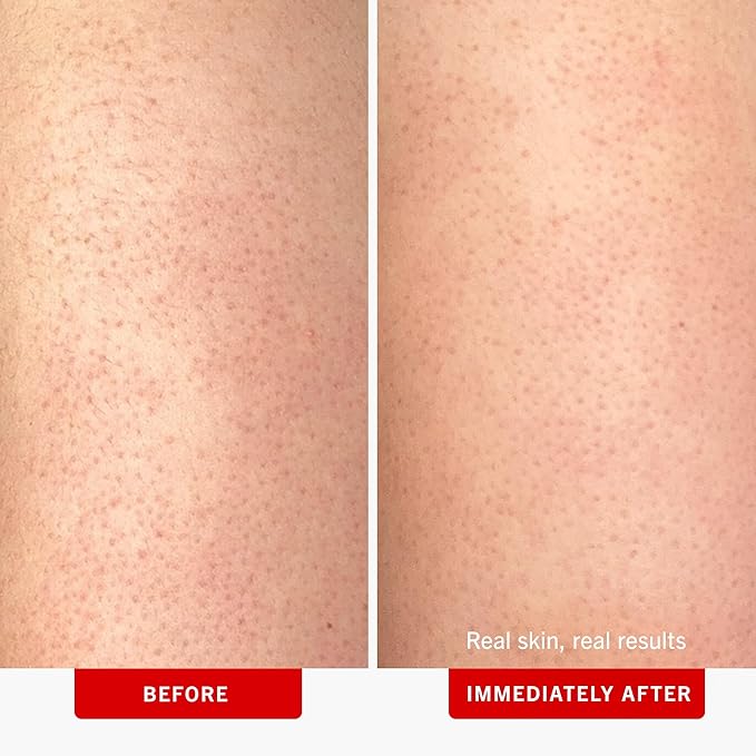 First Aid Beauty - KP Bump Eraser Body Scrub with 10% AHA, Keratosis Pilaris Skin Exfoliator with Glycolic and Lactic acids, Helps Reduce Chicken Bumps, Safe for Sensitive Skin, 2 oz