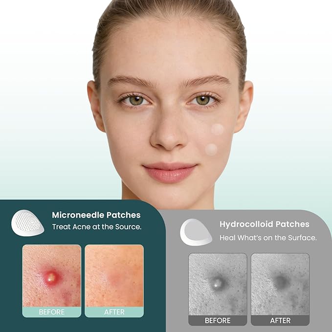 YOEYOU Micro-Dart Pimple Patch – Hydrocolloid Acne Patches with Micro-Dart Technology for Hydrolyzed Hyaluronic Acid, Salicylic Acid, Madecassoside & Tea Tree (18 Pack)
