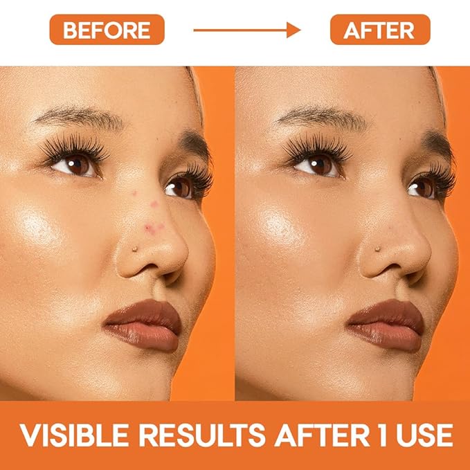 EZACNE™ Pimple Patches for Nose – Hydrocolloid Nose Pimple Patches for Zits, Blemishes & Excess Oil – Overnight Pore & Whitehead Nose Strips (12 Count)