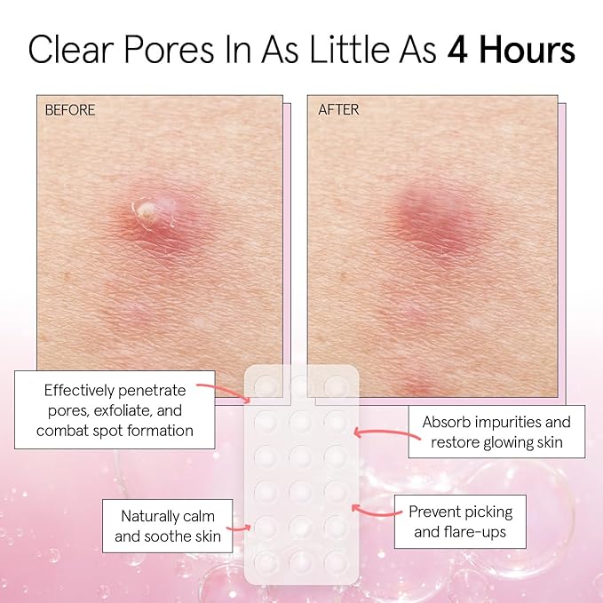 grace & stella Award Winning Pore Strip Pimple Patches for Face - Hydrocolloid Acne Patches for Shrinking Zits, Whiteheads - Spot Stickers - Dermatologist-Tested, Vegan (Invisible, 72 Count)