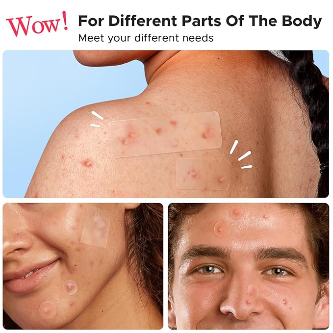 6、LitBear Large Pimple Patches, 5 Sizes 324 Patche Big Acne Patches, XL Hydrocolloid Bandages for Full Face, Forehead, Chin, Nose, Body, Back, Neck & Chest, Stirp, Square Large hydrocolloid Patch