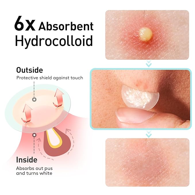 Pimple Patches, 15 mm Invisible Acne Patches for Face with Salicylic Acid, 0.01cm Extra Thin Outer Edge, Hydrocolloid Zit Patch for Pustule, Whitehead, Cystic Acne Spot, 96 Count