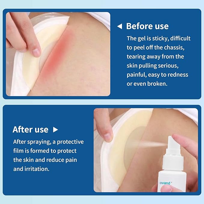 No Sting Ostomy Barrier Spray - Skin Barrier Film for Sensitive Skin - Skin Barrier for Protection Around Stomas and Wounds