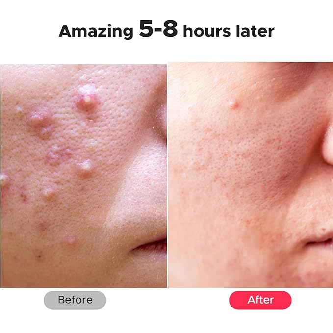 6、LitBear Large Pimple Patches, 5 Sizes 324 Patche Big Acne Patches, XL Hydrocolloid Bandages for Full Face, Forehead, Chin, Nose, Body, Back, Neck & Chest, Stirp, Square Large hydrocolloid Patch