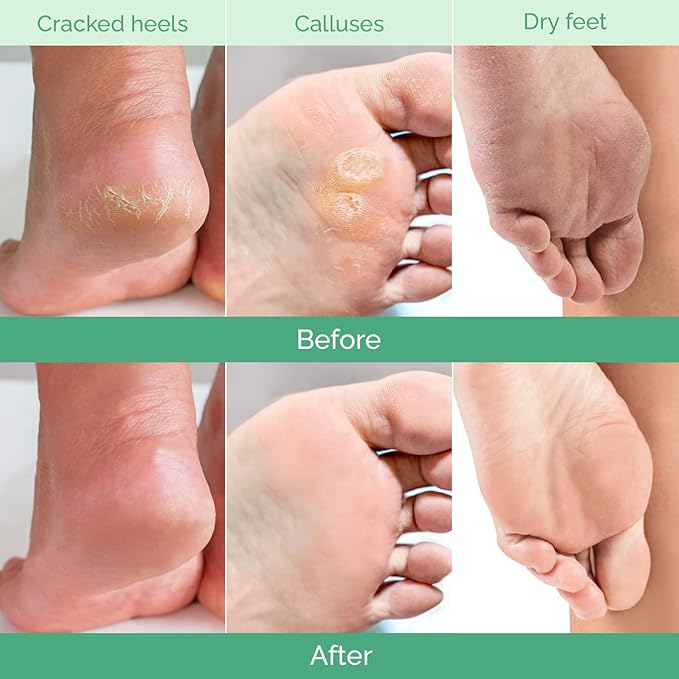PLANTIFIQUE Foot Peeling Mask 4 Pack | Dermatologically Tested Repairs Heels & Removes Dry Dead Skin for Baby Soft Feet | Exfoliating Foot Peel Mask for Dry Cracked Feet | Peach