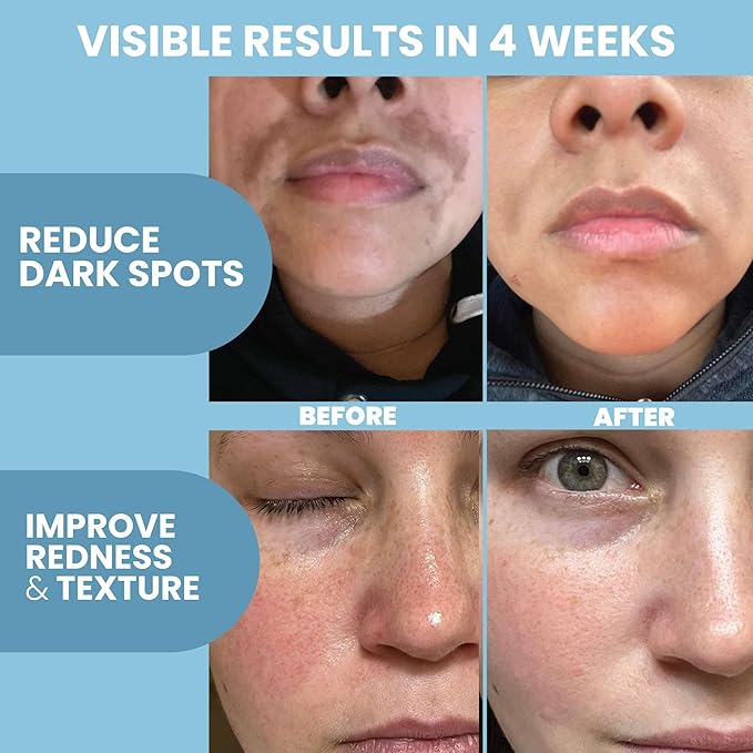 Eva Naturals 10% Azelaic Acid Serum for Face – Niacinamide, Hyaluronic Acid – Redness Relief, Dark Spots, Uneven Skin Tone, Texture, Pores, Topical Booster for Clearer, Smoother Skin, 1oz
