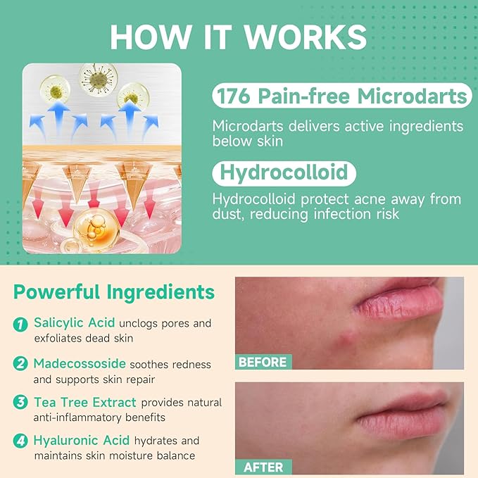 TEAWOO 72-Count Microdart Acne Patches, Hydrocolloid Pimple Patches with Salicylic Acid & Madecossoside, Microdart Zit Patches for Deep Blemishes & Early Stage Acne (Patented)