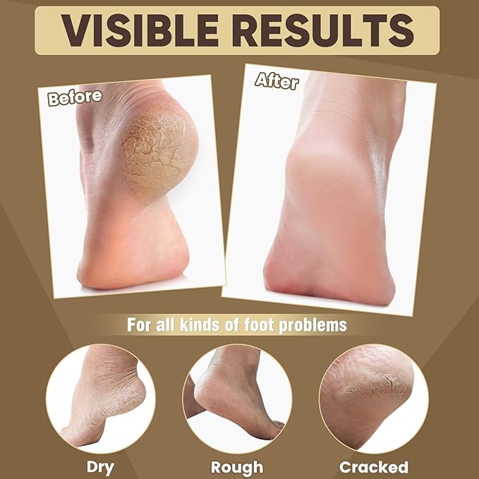 TEAWOO 18 Pairs Moisturizing Foot Masks with Castor Oil & Jojoba Oil, Intensely Hydrating Foot Mask For Dry Cracked Feet, Moisturizing Socks for Cracked Heel Treatment