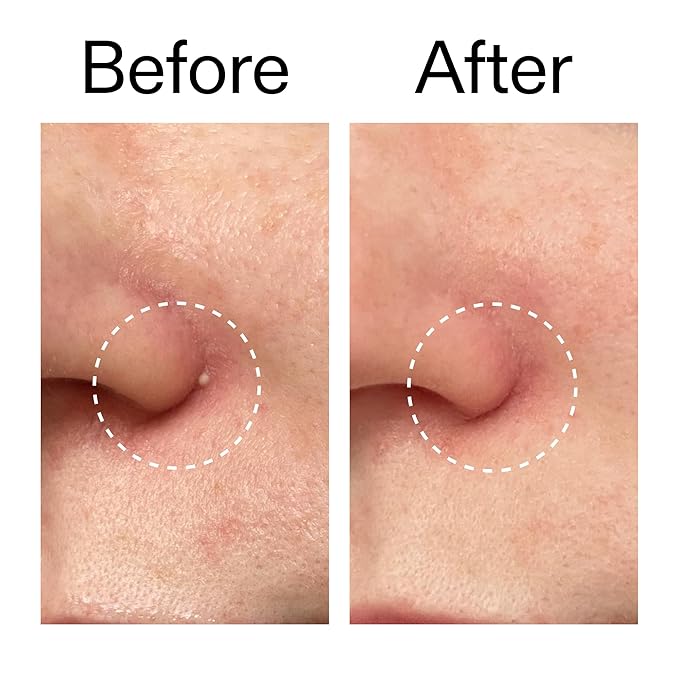 The INKEY List Hydrocolloid Invisible Pimple Patches, Spot Patches Contains Salicylic Acid, Day/Night Anti Acne Patches, Vegan & Cruelty Free, Suitable For All Skin Types