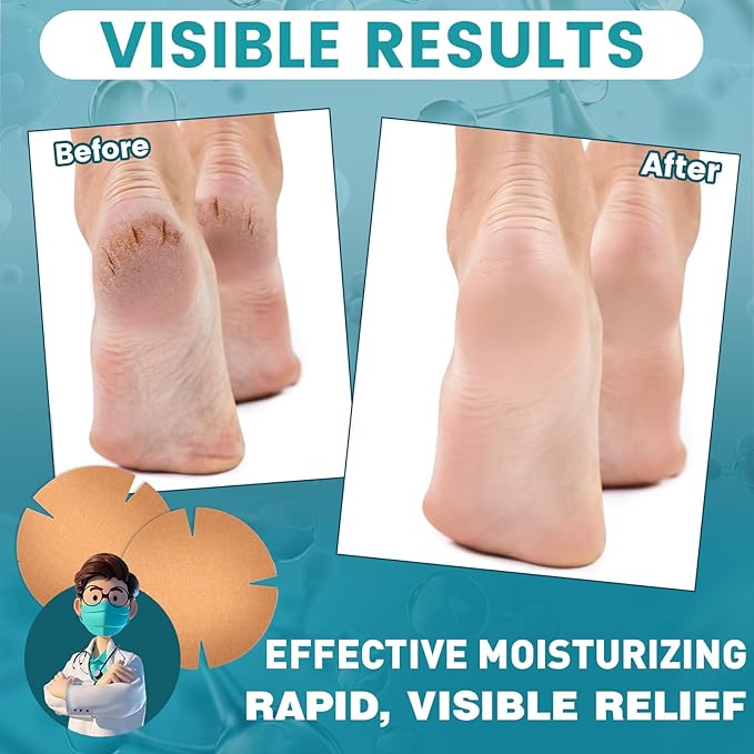 TEAWOO 30PCS Patented Cracked Heel Treatment Patches, New Upgraded Cracked Heel Repair Bandage (80mm x 80mm)