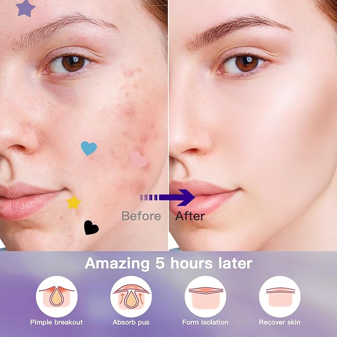 312CT Star Pimple Patches for Face Hydrocolloid Mighty Patch Star&Invisible Acne Patches,5Sizes 6Colors Cute Stickers Acne Pads Parches Acne For Body,Chin,Forehead,Full Face Zit Patch Acne Dots