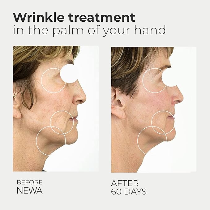NEWA RF Wrinkle Reduction Device (Wireless) - Skincare Tool for Facial Tightening. Boosts Collagen, Reduces Wrinkles. with 1 Month Gel Supply