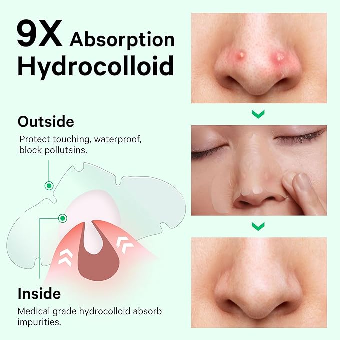 Sosky Patches for Nose, Hydrocolloid Pimple & Pore Nose Patches, Absorbs Oil Overnight Nose Pore Strips, Targets Pimples, Zits and Pores, FSA Eligible Acne Patches, Clear Skin 14 Count