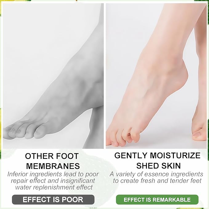 Shea Butter Foot Peel Mask 5 Pairs, Exfoliating Foot Masks for Dry Cracked Feet, Avocado Moisturizing Foot Mask Socks for Women & Men, Hydrating Foot Exfoliator for Soft Smooth Feet