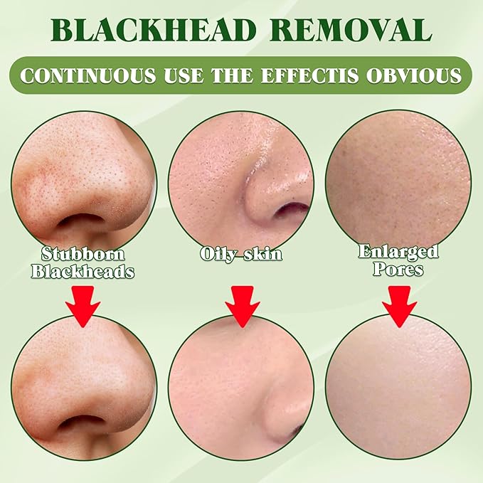 Eveellyn Blackhead Remover Strips, 10 Pcs Charcoal Pore Strips, Deep Cleansing Blackhead Strip for All Skin Type, Nose Strip Blackhead Remover, Keep Skin Clear and Tighten Pores