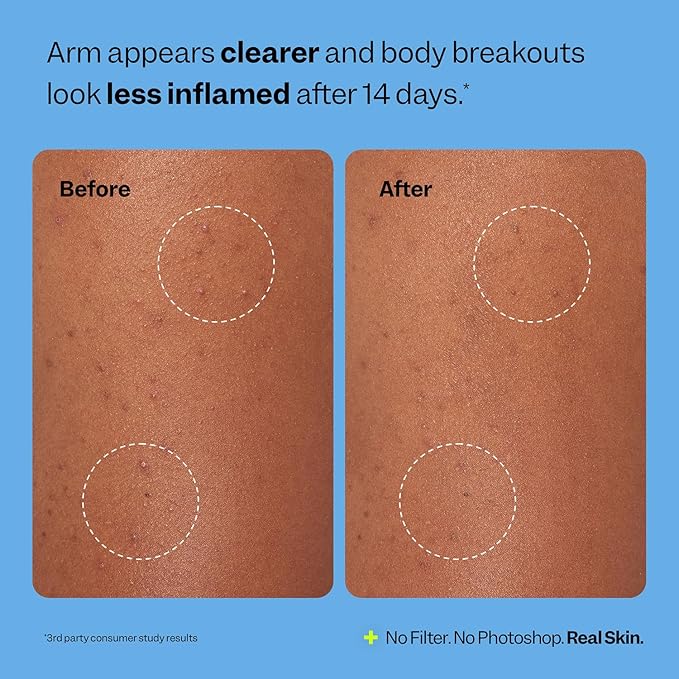 Peach Slices - Body Breakout Patches (6 ct) - Overnight Body Pimple Patches - Hypoallergenic - Flexible & Painless - Cica & Hydrocolloid Bandages - Vegan & Cruelty Free - Korean Skin Care & Beauty