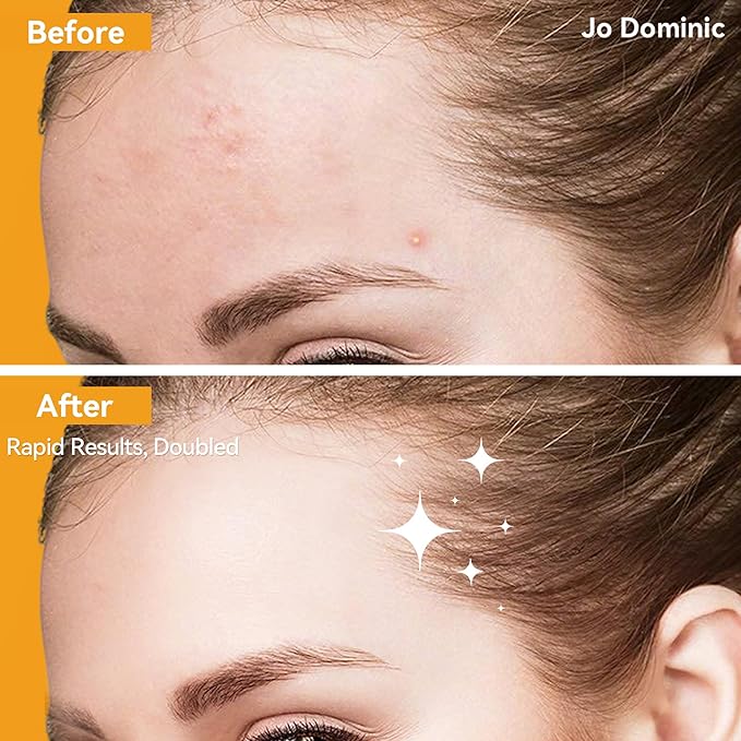 MAGIX PATCH Large Invisible Acne Patches by Jo Dominic – Hydrocolloid Big Forehead Pimple Patches/Zit Patches for Face – Absorbs Oil, Zits & Blemishes, Vegan-Friendly (16 Count)