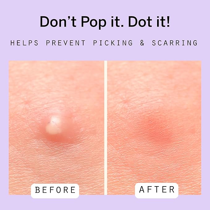 Pixie Cup Dot Hydrocolloid Blemish Patches for Face – Invisible Skin-Covering Stickers with Tea Tree Oil & Vitamin C – Ultra-Thin Cosmetic Patches for Visible Blemishes (10 mm, 80 ct)
