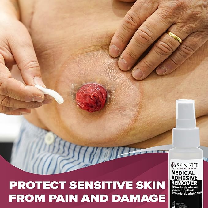 Medical Adhesive Remover for Skin | Wig, Ostomy, Tape, and Bandage Adhesive Remover | Silicone-Based, Hypoallergenic, Sting-Free | 2oz Spray