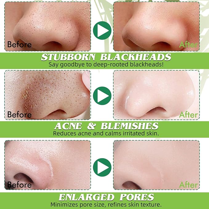 Blackhead Remover Strip, Deep Cleansing Charcoal Strips, Powerfully Absorbs Blackheads, Whiteheads & Oil-control Nose Strip, Nose Pore Strips for Unisex & All Skin Types